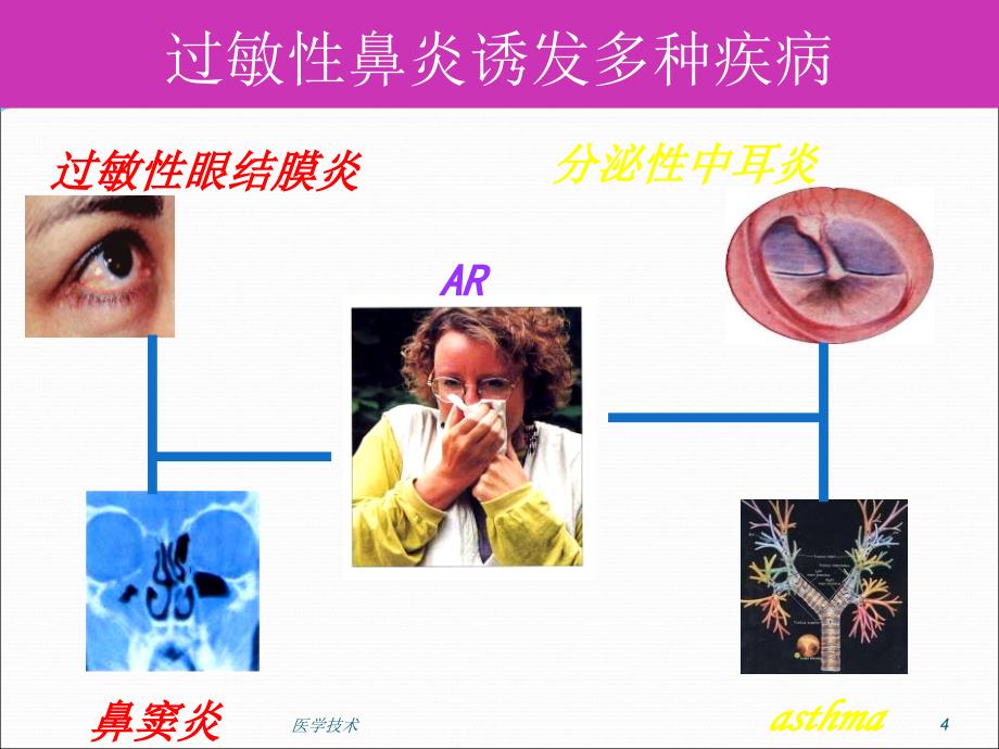 过敏性疾病过敏性鼻炎医学技术_第4页