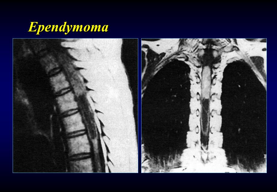 椎管内肿瘤-神经外科教学课件.ppt_第4页