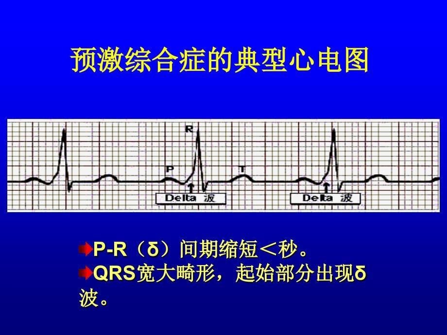 常预激综合征课件_第5页