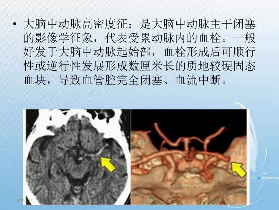 超早期脑梗死的CT影像表现及诊断课件_第5页