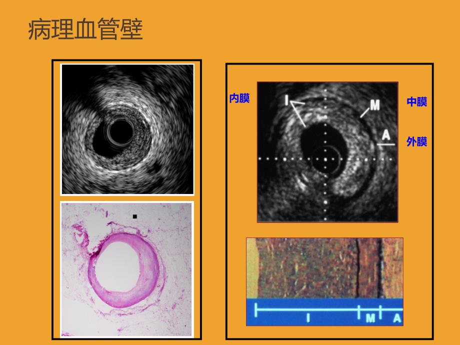 血管内超声IVUS基础基本图像分析培训ppt课件_第3页