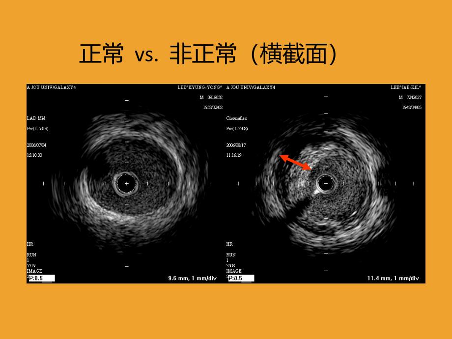 血管内超声IVUS基础基本图像分析培训ppt课件_第4页