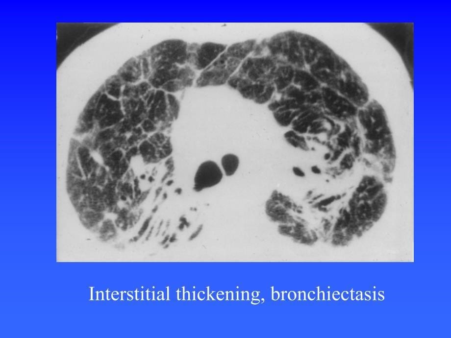 常见肺部弥漫性疾病的CT诊断_第5页