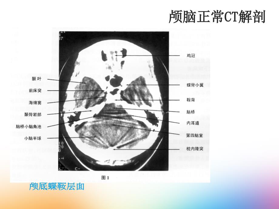 头部CT诊断学ppt课件_第4页