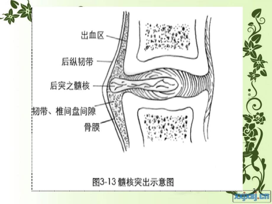 颈椎病PPT课件_第3页