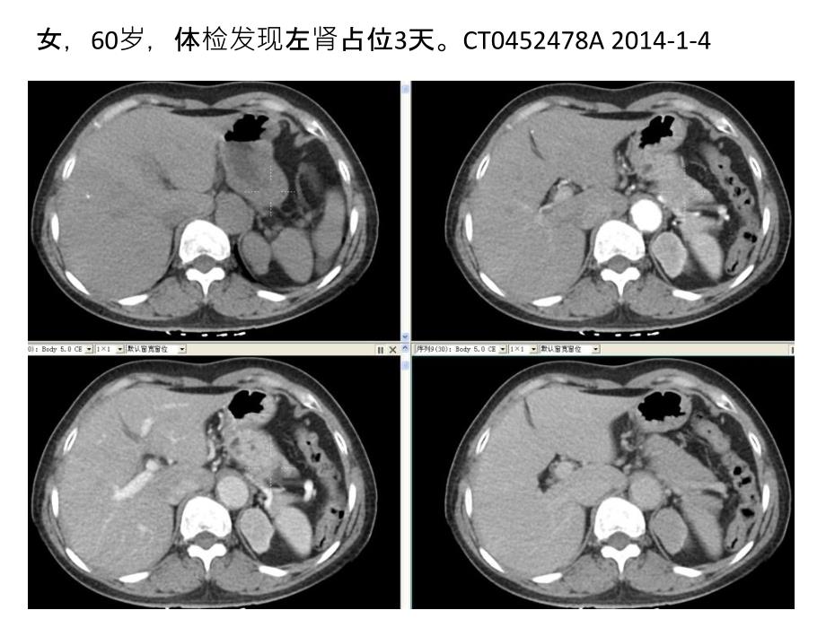 肾血管平滑肌脂肪瘤病例_第1页