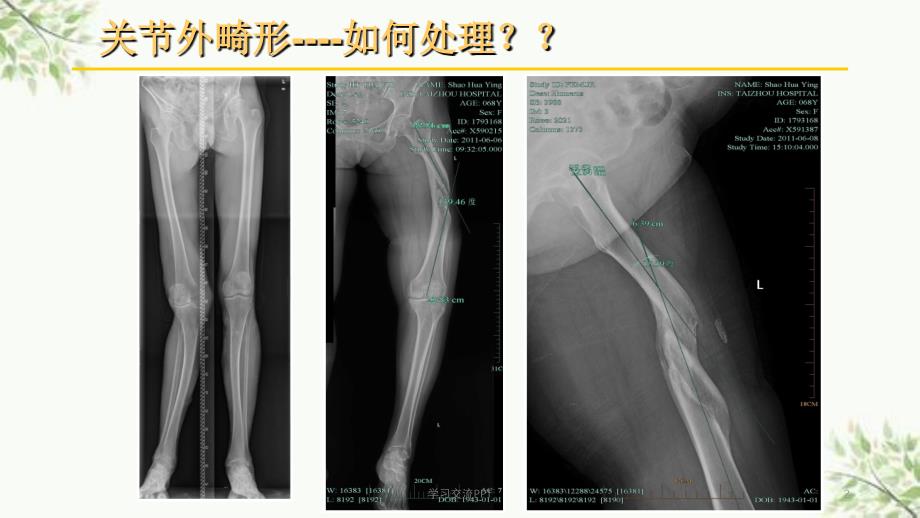 关节外畸形全膝医学课件_第2页