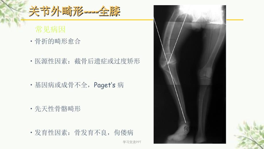 关节外畸形全膝医学课件_第4页