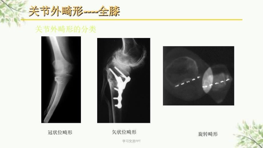 关节外畸形全膝医学课件_第5页