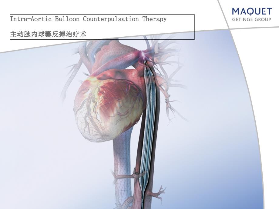 主动脉内球囊反搏术ppt课件1_第1页