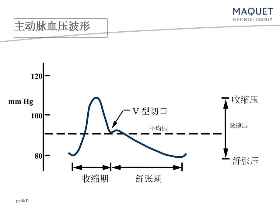 主动脉内球囊反搏术ppt课件1_第5页