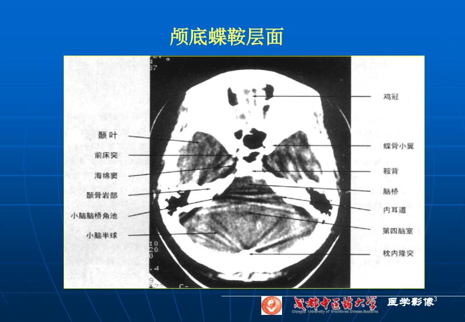 脑部断层课堂PPT_第3页