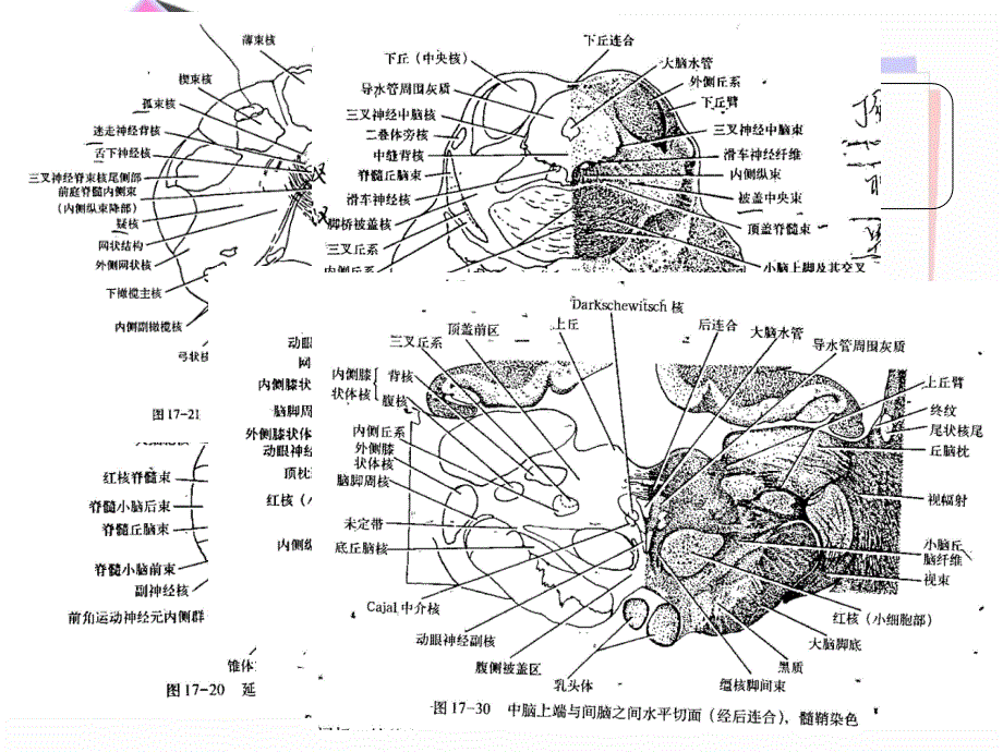 常见的脑干损害综合征文档资料_第3页