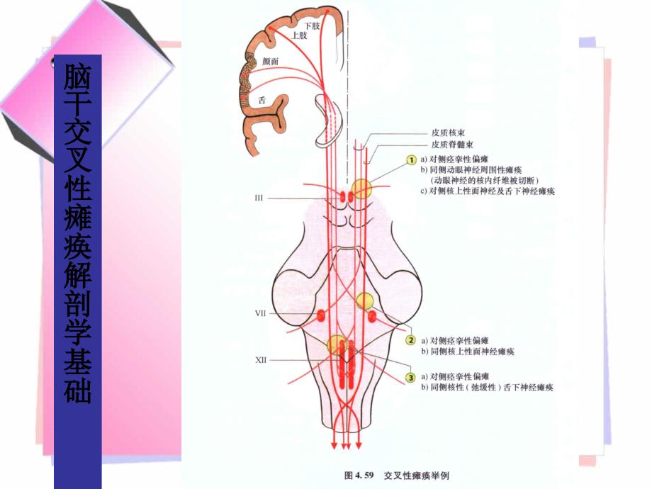 常见的脑干损害综合征文档资料_第4页