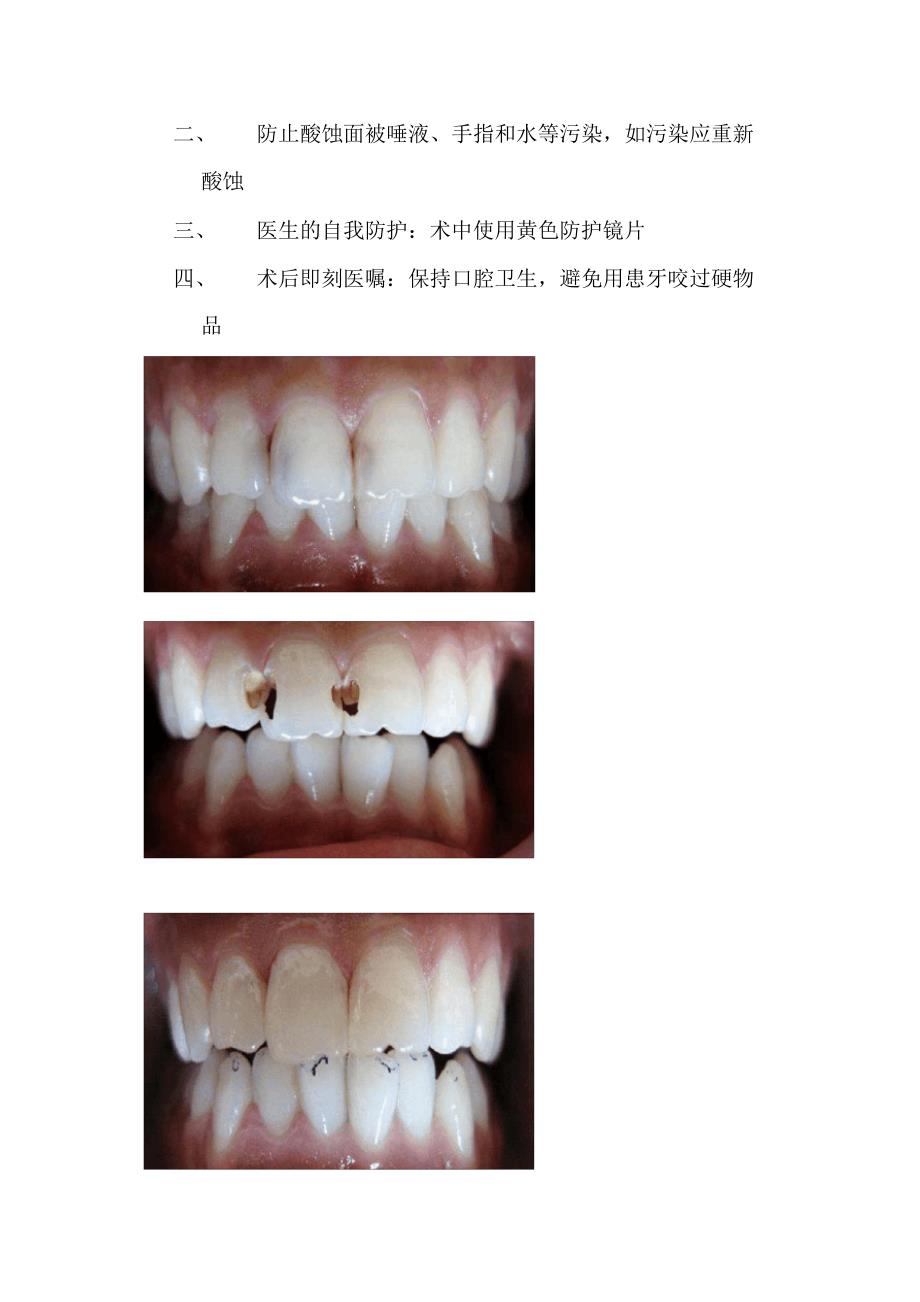 光固化树脂充填术_第3页