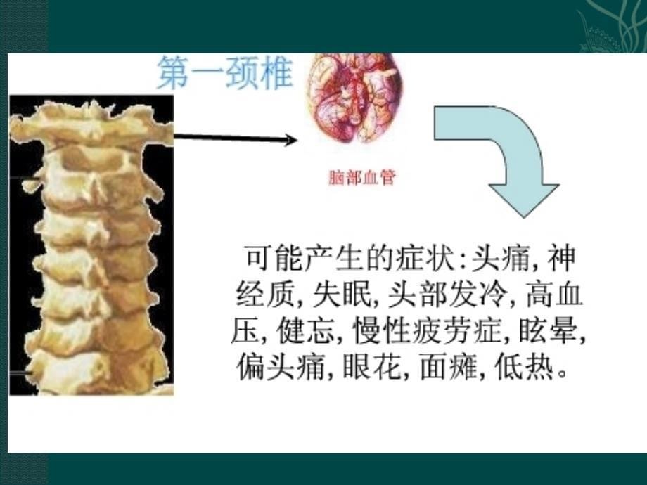 颈椎病诊疗及康复锻炼ppt课件_第5页