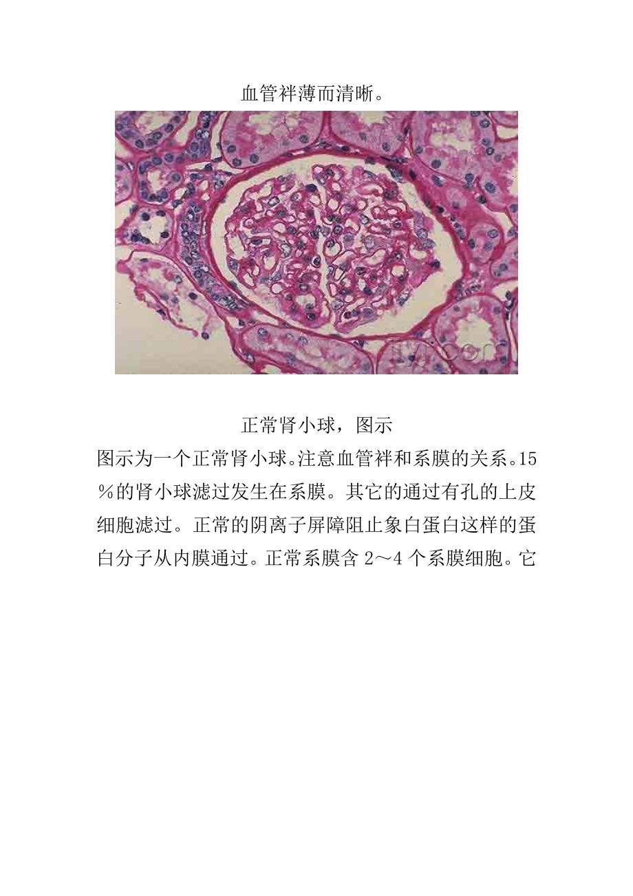 肾脏病理图片肾小球肾炎病理图片_第2页