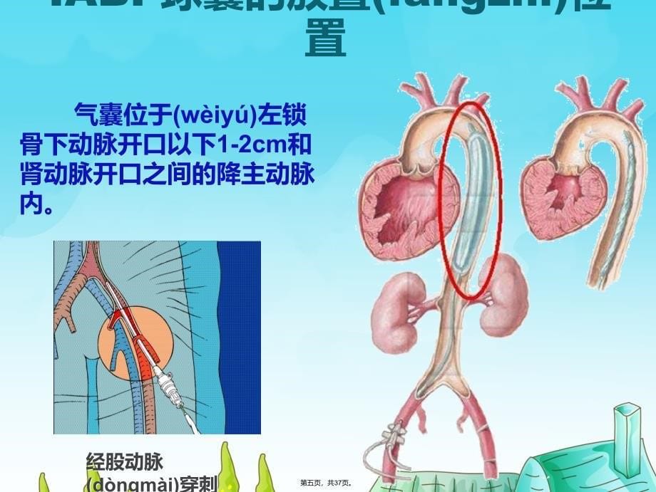 主动脉内球囊反搏的基本理论及护理要点复习过程_第5页