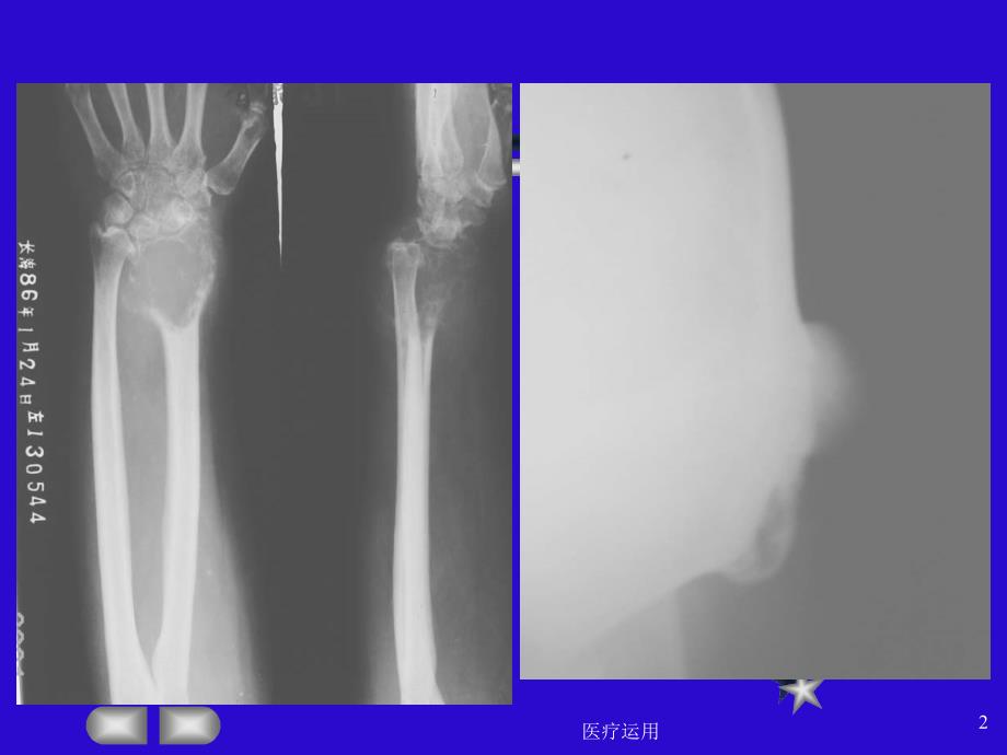 骨肿瘤的X线表现【医疗经验】_第2页