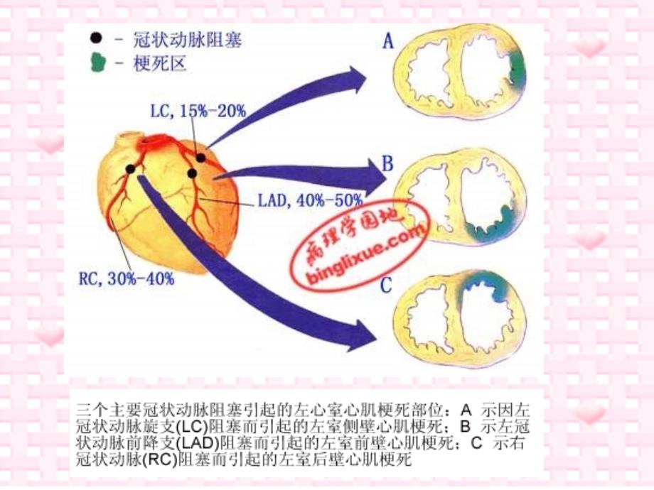 室壁瘤术后护理李旭_第3页