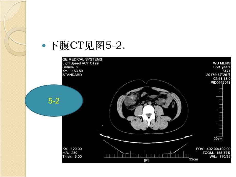 阑尾炎教学查房经典教案_第5页