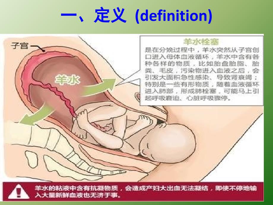 羊水栓塞的护理ppt课件_第3页