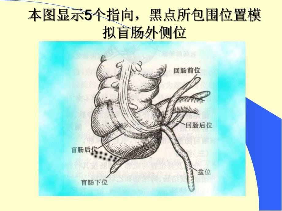 实用阑尾炎PPT课件_第5页