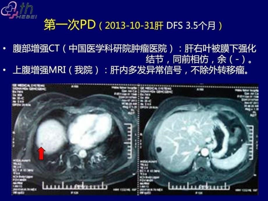 乳腺癌典型病例讨论一例图文.ppt_第5页