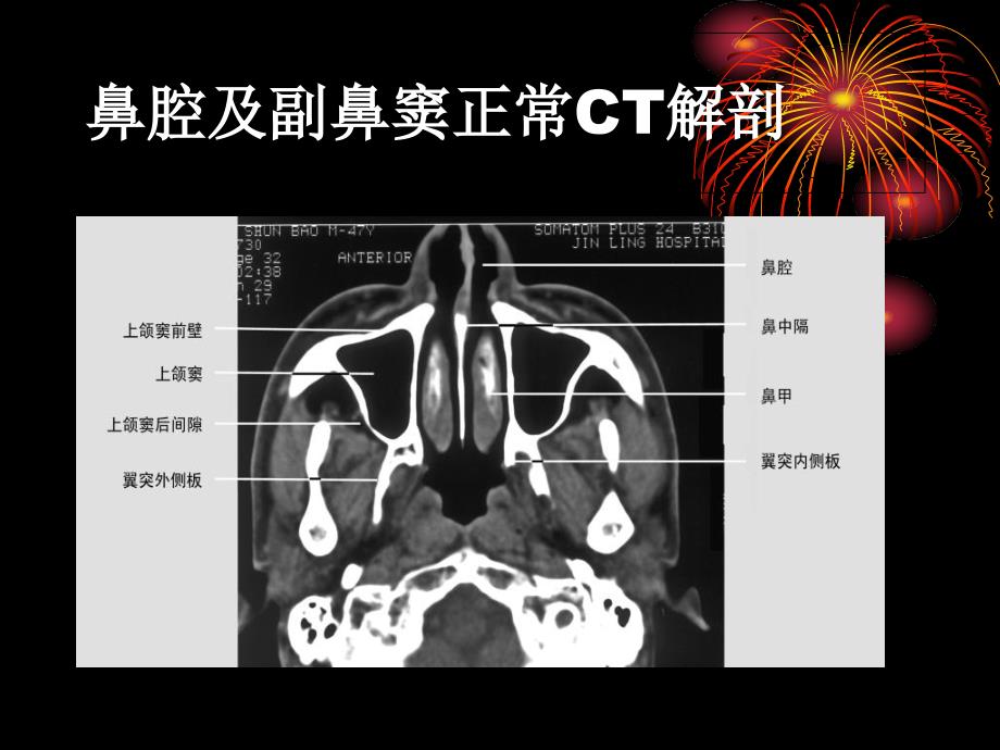 鼻和鼻窦病变CT诊断PPT课件_第1页