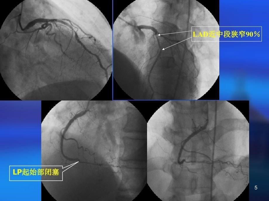 冠心病诊断与胸痛鉴别诊断_第5页