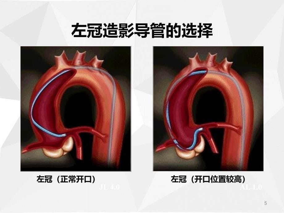 冠状动脉造影的基本方法及病变分析_第5页