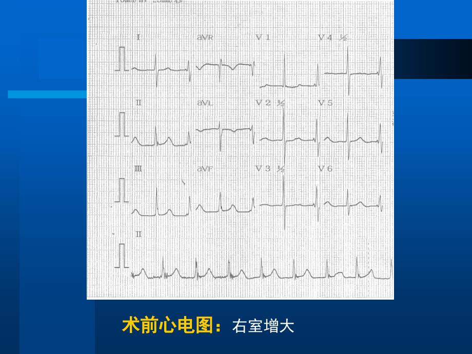 房缺介入封堵一例教学课件_第3页