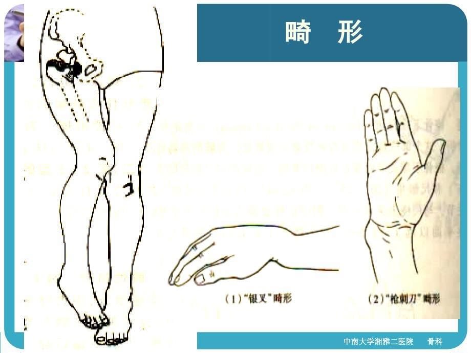 四肢骨折经典ppt课件_第5页