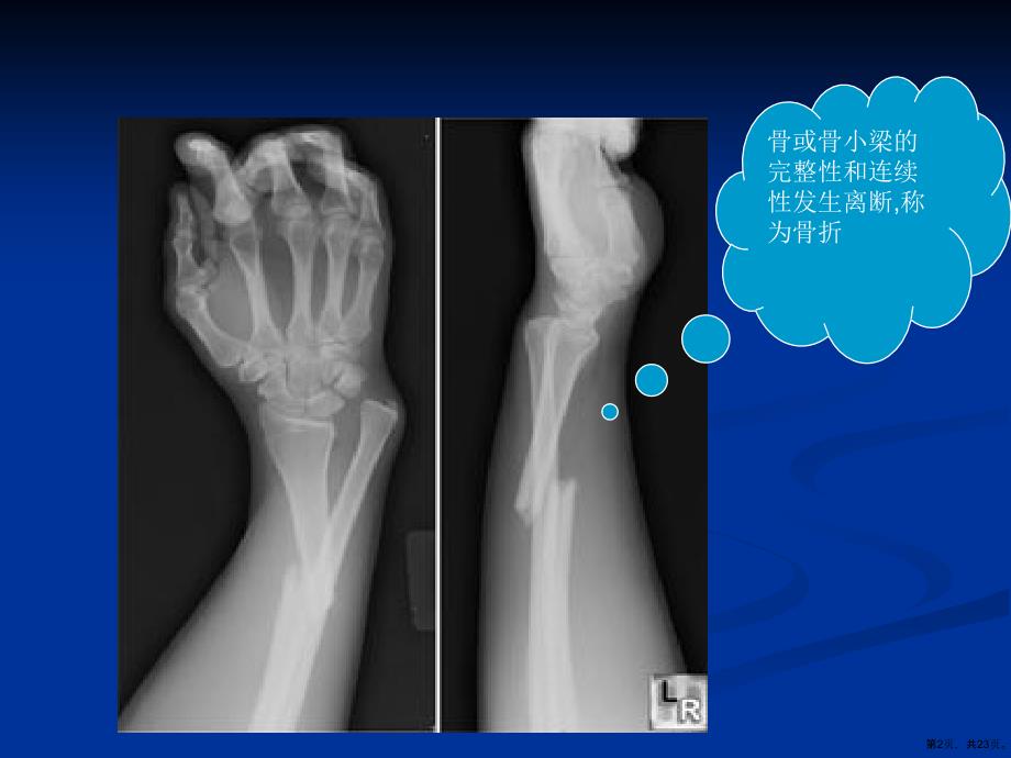 (整理版)骨折的康复课件_第2页