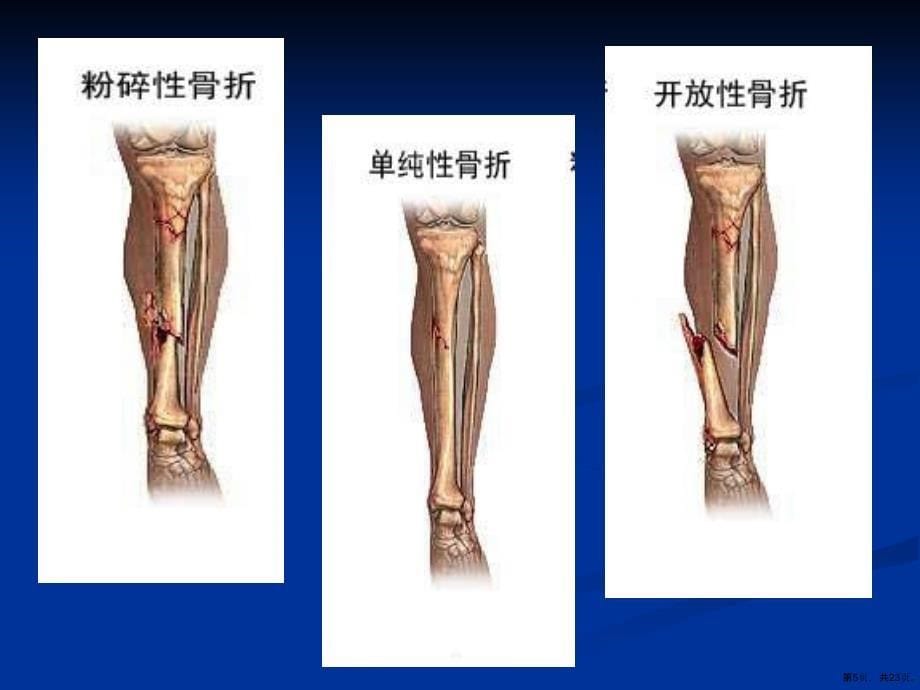 (整理版)骨折的康复课件_第5页