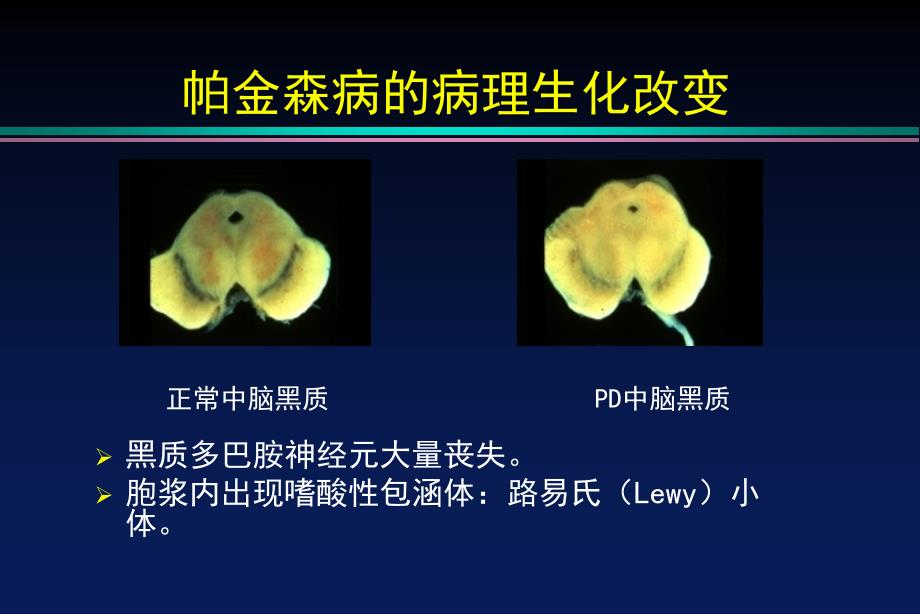 PD的诊断及治疗_第4页