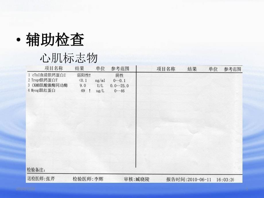 Brugada综合征ppt参考课件_第5页