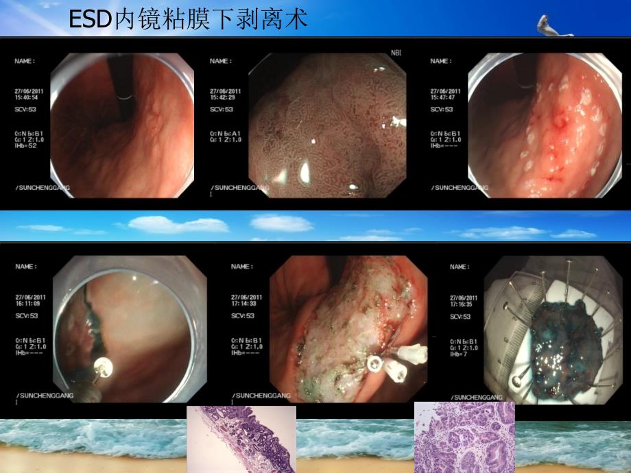 消化内镜治疗新技术_第4页