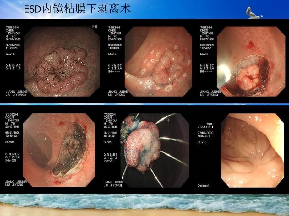 消化内镜治疗新技术_第5页