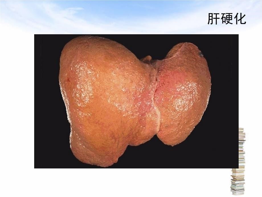 肝硬化腹水护理查房_第5页