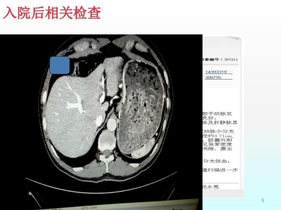 肾癌最终版ppt课件_第5页