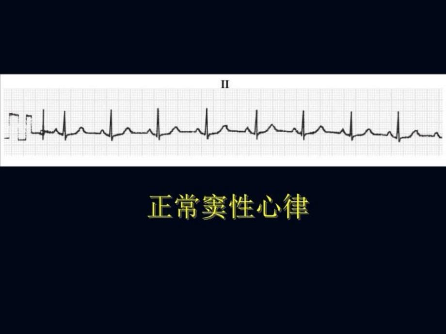 最新心律失常识别与治疗PPT课件_第3页