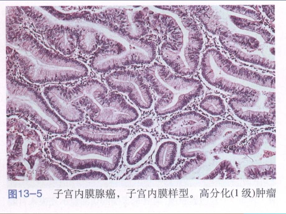 子宫内膜癌的新分类_第4页