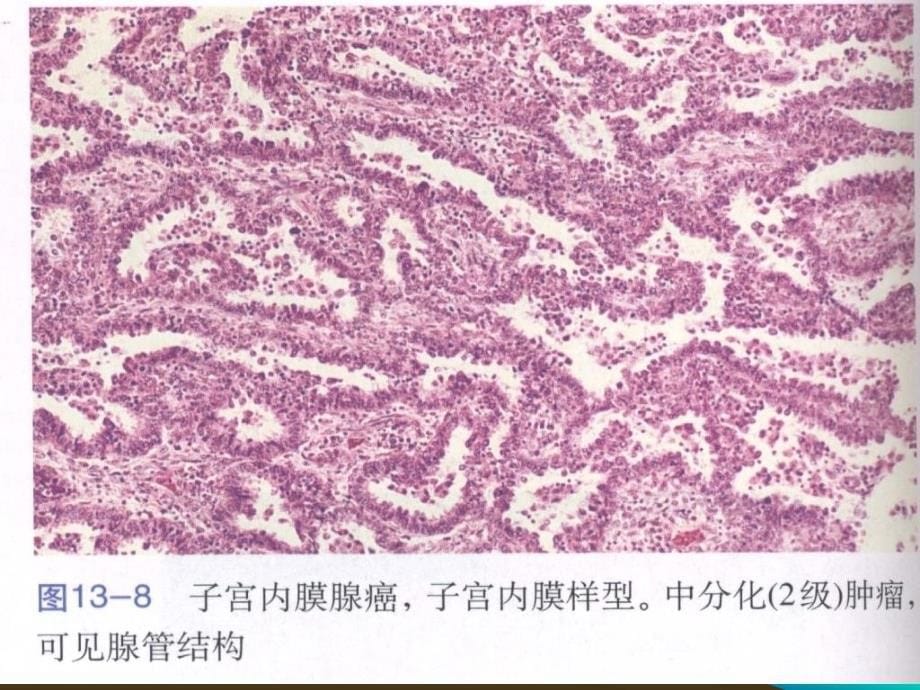 子宫内膜癌的新分类_第5页