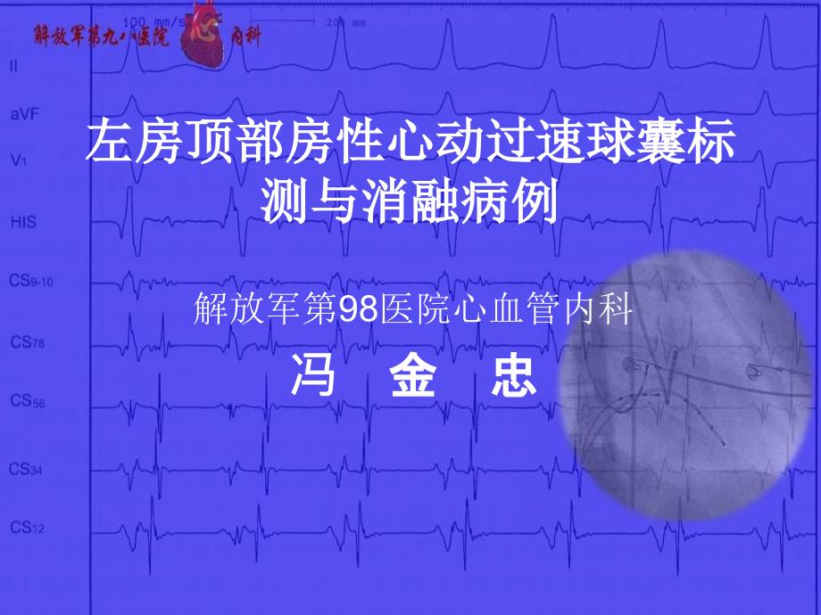 左房顶部房性心动过速球囊标测与消融病例_第1页