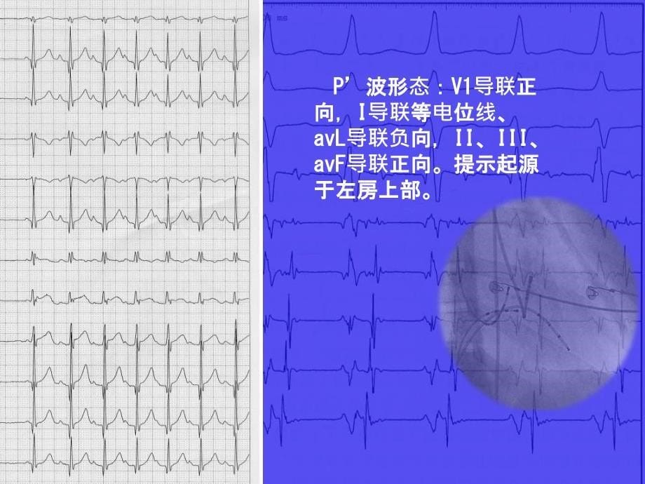 左房顶部房性心动过速球囊标测与消融病例_第5页