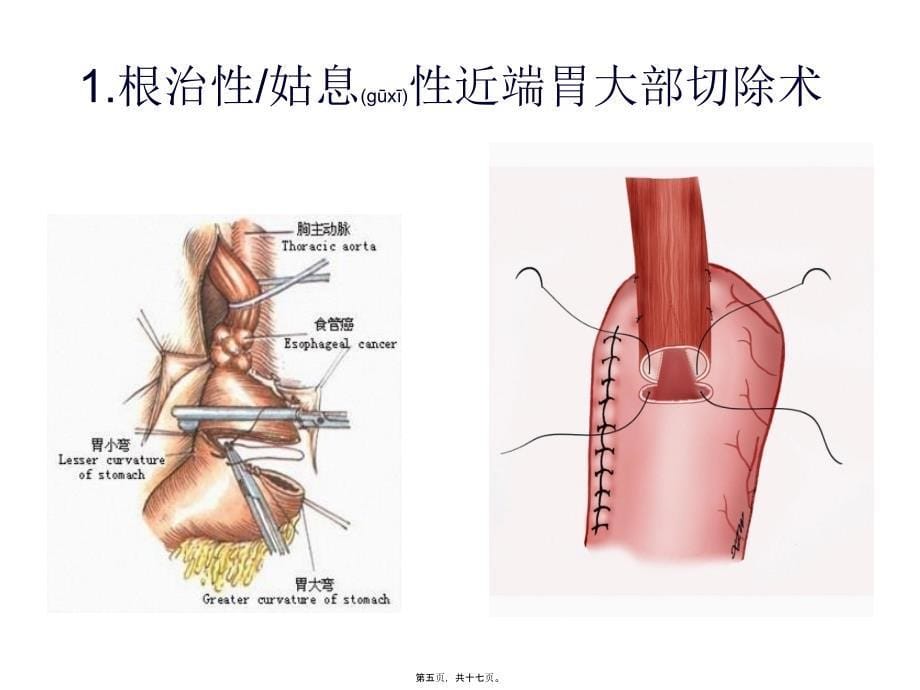 医学专题—胃癌常见手术方式及术后并发症_第5页