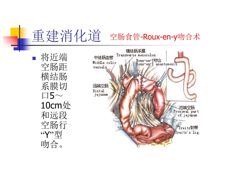 图解全胃切除手术PPT课件_第2页