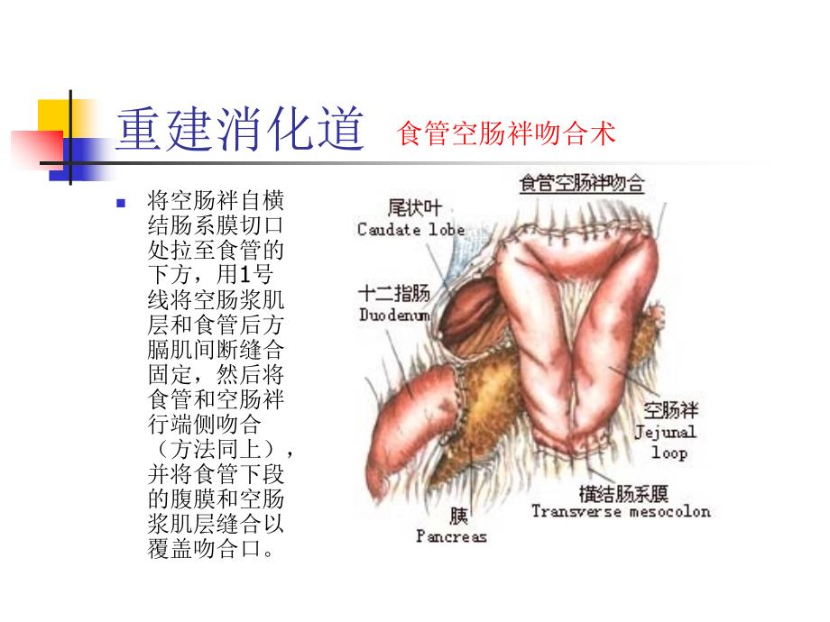 图解全胃切除手术PPT课件_第4页