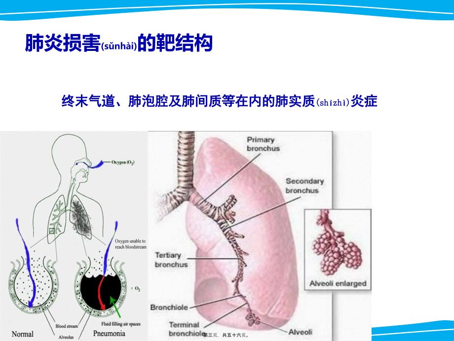 医学专题—严重肺部感染诊治策略_第3页